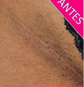 Antes e depois do clareamento de virilha